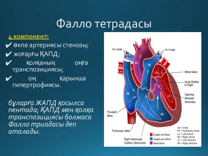 Фалло тетрадасы 4 компонент: өкпе артериясы стенозы; жоғарғы ҚАПД; қолқаның оңға транспозициясы;