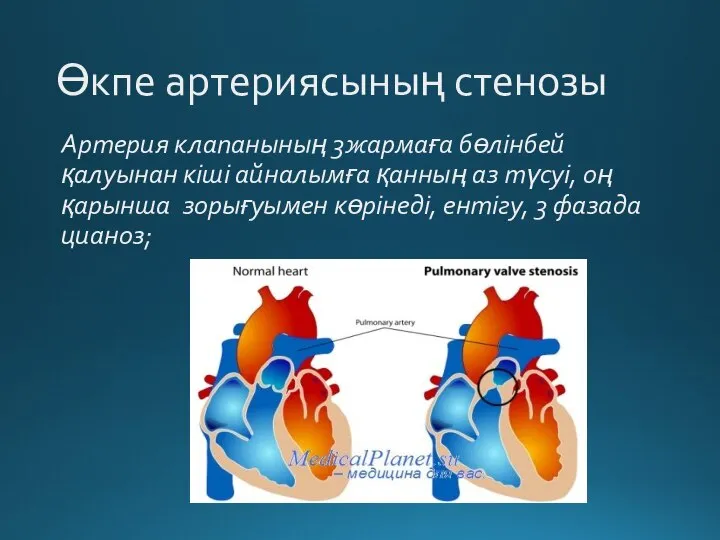 Өкпе артериясының стенозы Артерия клапанының 3жармаға бөлінбей қалуынан кіші айналымға қанның аз