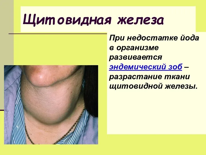 Щит овидная железа При недостатке йода в организме развивается эндемический зоб – разрастание ткани щитовидной железы.