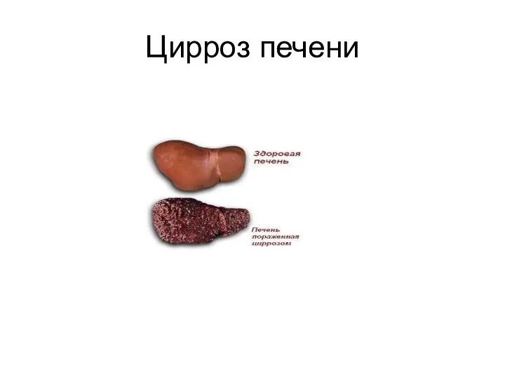 Цирроз печени