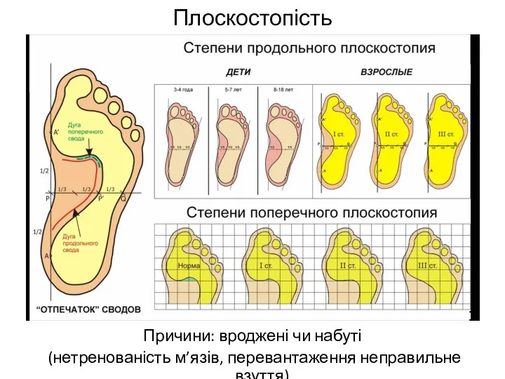 Плоскостопість Причини: вроджені чи набуті (нетренованість м’язів, перевантаження неправильне взуття)