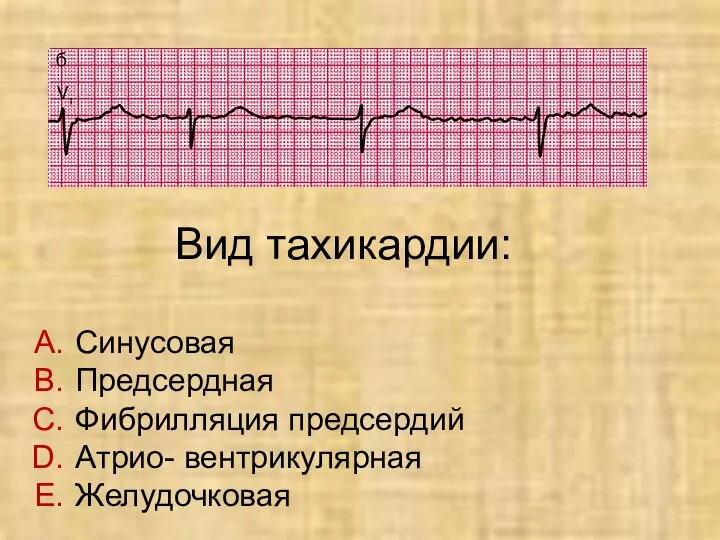 Вид тахикардии: Синусовая Предсердная Фибрилляция предсердий Атрио- вентрикулярная Желудочковая