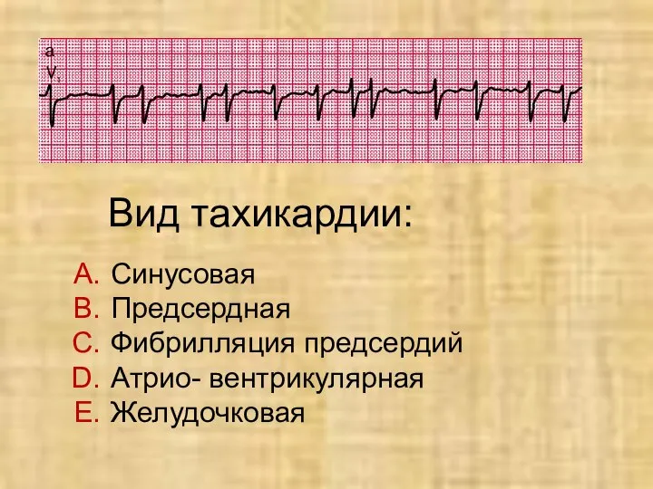 Вид тахикардии: Синусовая Предсердная Фибрилляция предсердий Атрио- вентрикулярная Желудочковая