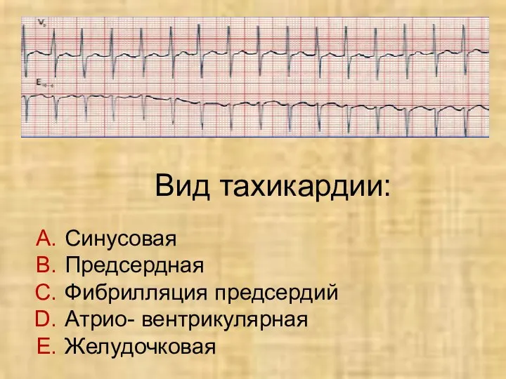 Вид тахикардии: Синусовая Предсердная Фибрилляция предсердий Атрио- вентрикулярная Желудочковая