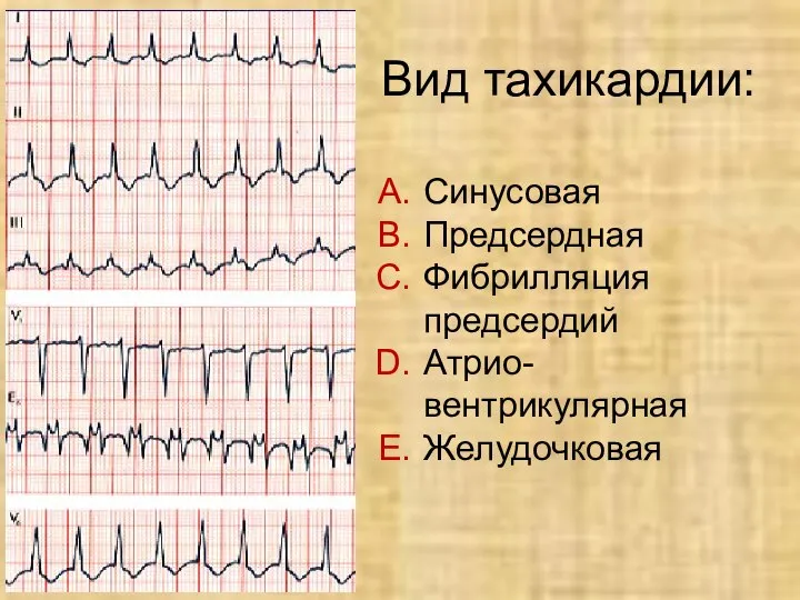 Вид тахикардии: Синусовая Предсердная Фибрилляция предсердий Атрио- вентрикулярная Желудочковая