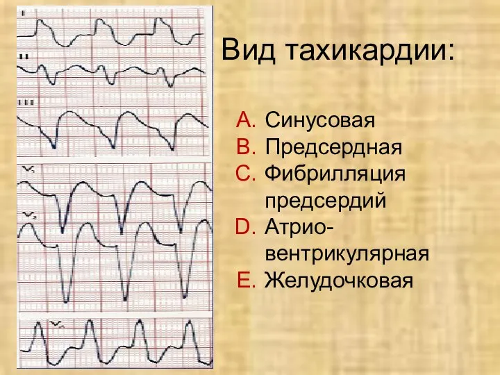 Вид тахикардии: Синусовая Предсердная Фибрилляция предсердий Атрио- вентрикулярная Желудочковая