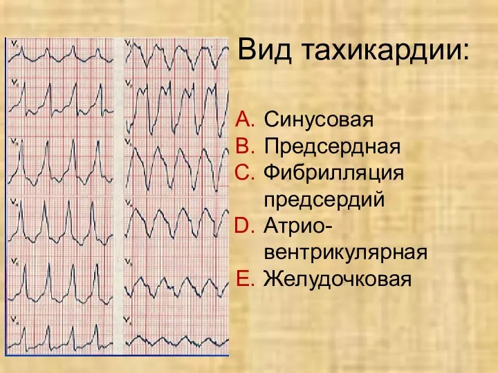 Вид тахикардии: Синусовая Предсердная Фибрилляция предсердий Атрио- вентрикулярная Желудочковая