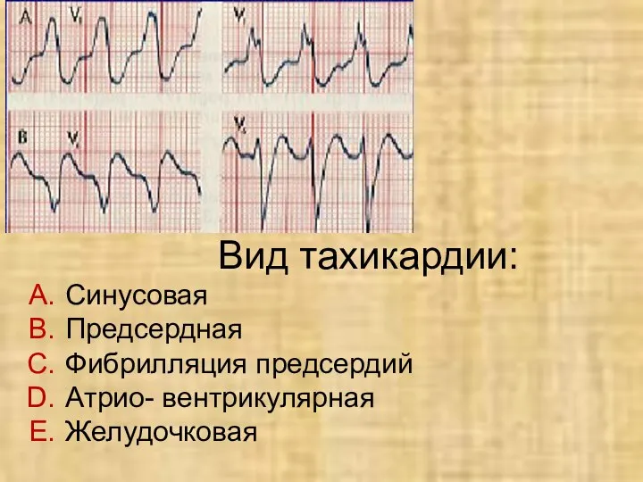 Вид тахикардии: Синусовая Предсердная Фибрилляция предсердий Атрио- вентрикулярная Желудочковая