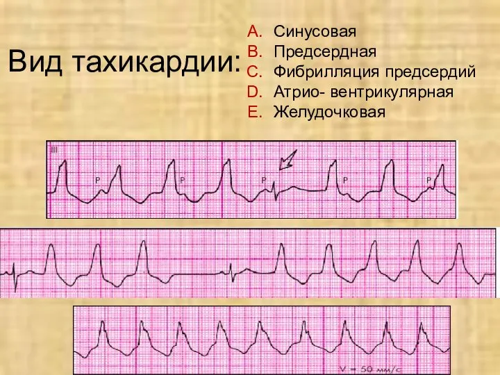 Вид тахикардии: Синусовая Предсердная Фибрилляция предсердий Атрио- вентрикулярная Желудочковая