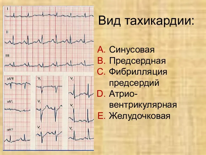 Вид тахикардии: Синусовая Предсердная Фибрилляция предсердий Атрио- вентрикулярная Желудочковая