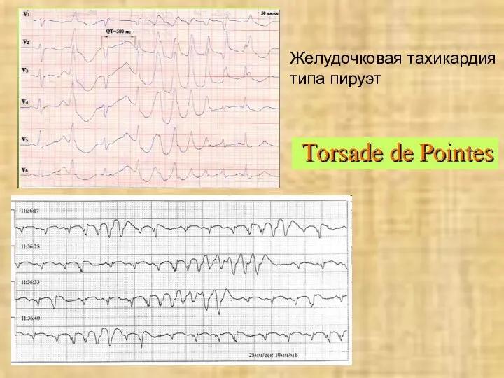 Желудочковая тахикардия типа пируэт