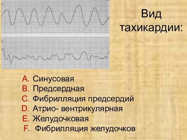 Вид тахикардии: Синусовая Предсердная Фибрилляция предсердий Атрио- вентрикулярная Желудочковая Фибрилляция желудочков