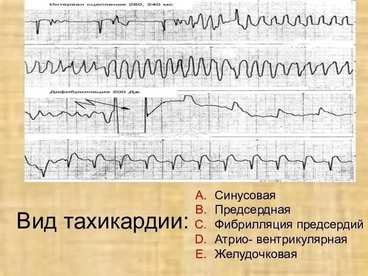 Вид тахикардии: Синусовая Предсердная Фибрилляция предсердий Атрио- вентрикулярная Желудочковая