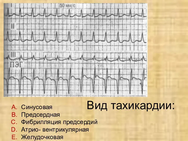 Синусовая Предсердная Фибрилляция предсердий Атрио- вентрикулярная Желудочковая Вид тахикардии: