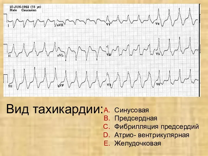 Вид тахикардии: Синусовая Предсердная Фибрилляция предсердий Атрио- вентрикулярная Желудочковая