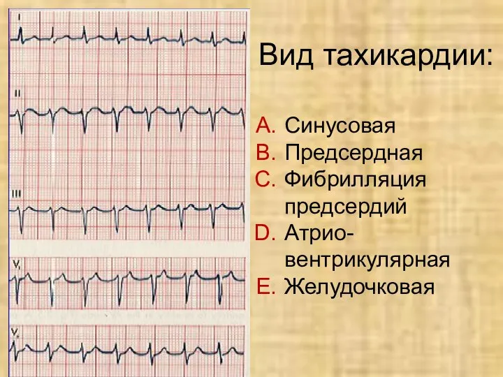 Вид тахикардии: Синусовая Предсердная Фибрилляция предсердий Атрио- вентрикулярная Желудочковая