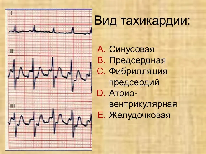 Вид тахикардии: Синусовая Предсердная Фибрилляция предсердий Атрио- вентрикулярная Желудочковая