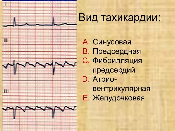 Вид тахикардии: Синусовая Предсердная Фибрилляция предсердий Атрио- вентрикулярная Желудочковая