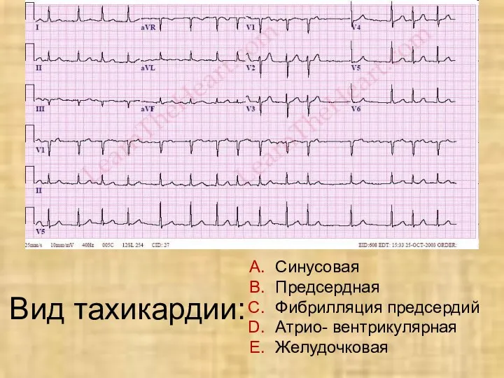 Вид тахикардии: Синусовая Предсердная Фибрилляция предсердий Атрио- вентрикулярная Желудочковая