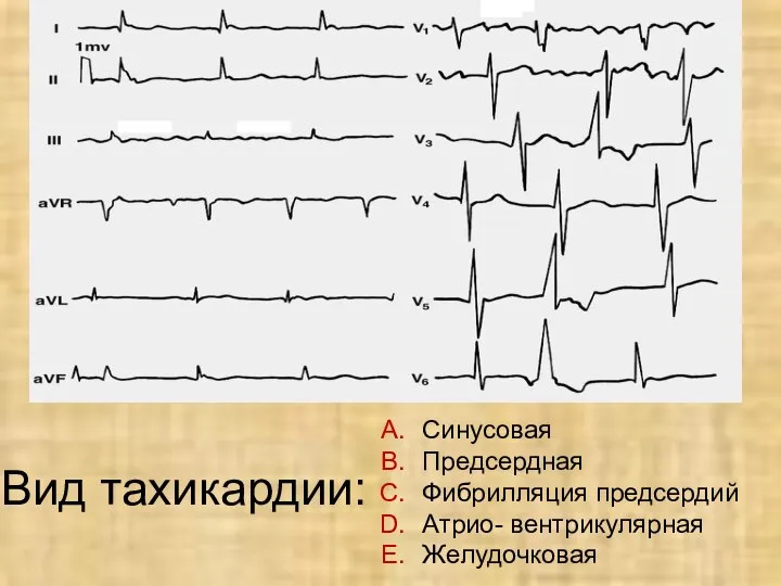 Вид тахикардии: Синусовая Предсердная Фибрилляция предсердий Атрио- вентрикулярная Желудочковая