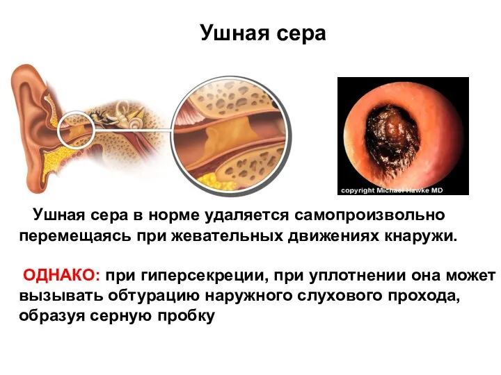 Ушная сера в норме удаляется самопроизвольно перемещаясь при жевательных движениях кнаружи. ОДНАКО: