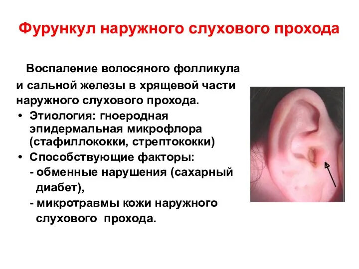 Фурункул наружного слухового прохода Воспаление волосяного фолликула и сальной железы в хрящевой