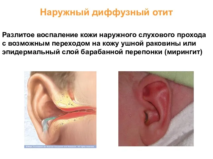Наружный диффузный отит Разлитое воспаление кожи наружного слухового прохода с возможным переходом