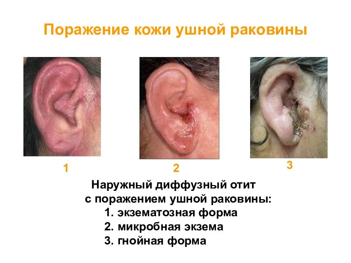 Поражение кожи ушной раковины 1 2 3 Наружный диффузный отит с поражением