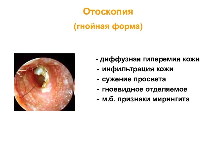 - диффузная гиперемия кожи инфильтрация кожи сужение просвета гноевидное отделяемое м.б. признаки мирингита Отоскопия (гнойная форма)