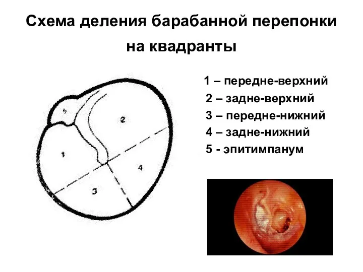 Схема деления барабанной перепонки на квадранты 1 – передне-верхний 2 – задне-верхний