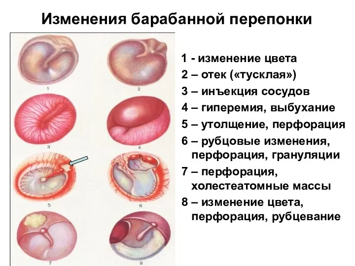 Изменения барабанной перепонки 1 - изменение цвета 2 – отек («тусклая») 3