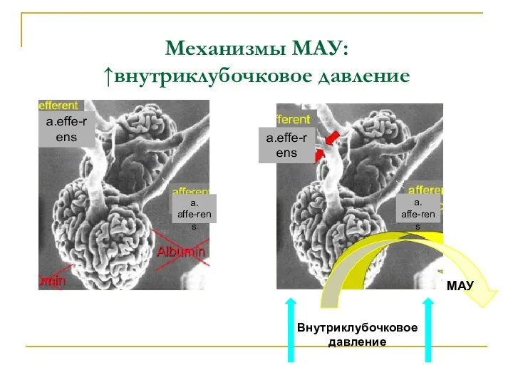 Механизмы МАУ: ↑внутриклубочковое давление a.effe-rens a. affe-rens Внутриклубочковое давление МАУ a.effe-rens a. affe-rens