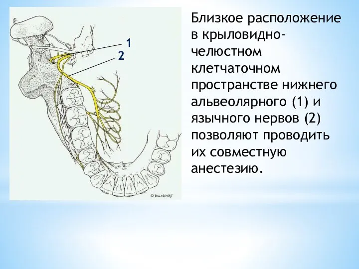 Близкое расположение в крыловидно-челюстном клетчаточном пространстве нижнего альвеолярного (1) и язычного нервов