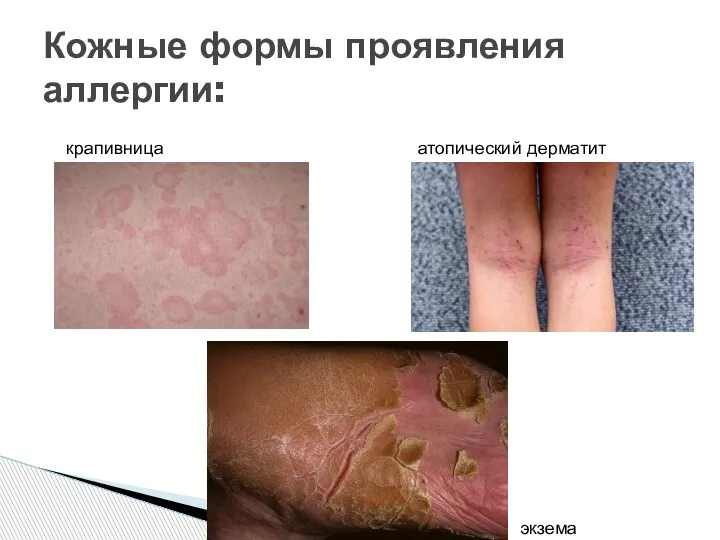 Кожные формы проявления аллергии: крапивница атопический дерматит экзема