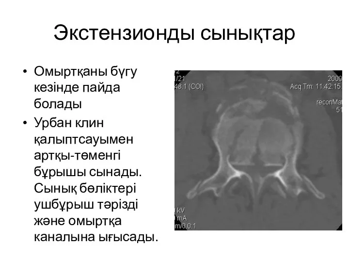 Экстензионды сынықтар Омыртқаны бүгу кезінде пайда болады Урбан клин қалыптсауымен артқы-төменгі бұрышы