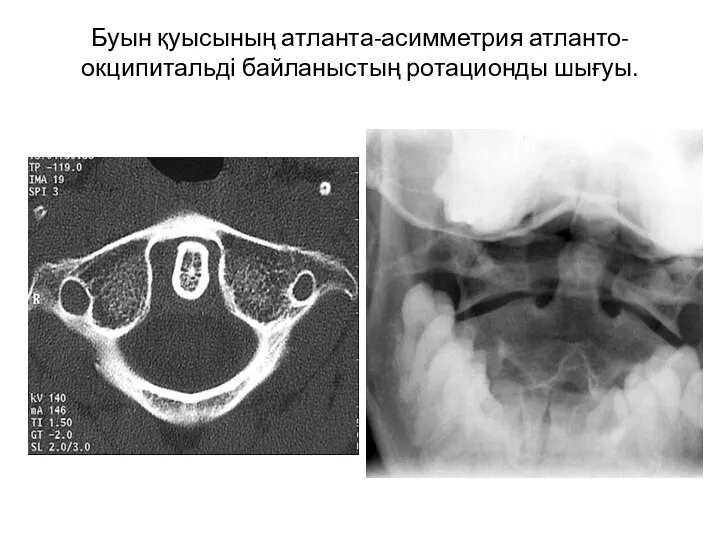 Буын қуысының атланта-асимметрия атланто-окципитальді байланыстың ротационды шығуы.