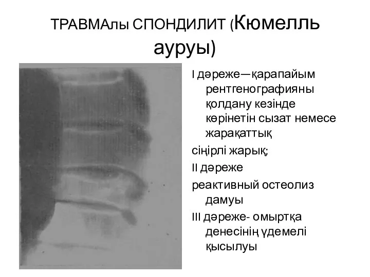 ТРАВМАлы СПОНДИЛИТ (Кюмелль ауруы) I дәреже—қарапайым рентгенографияны қолдану кезінде көрінетін сызат немесе