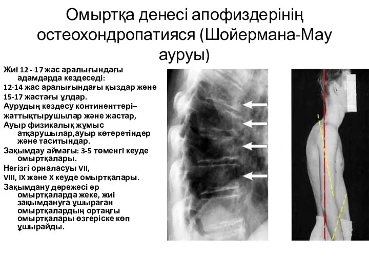 Омыртқа денесі апофиздерінің остеохондропатияся (Шойермана-Мау ауруы) Жиі 12 - 17 жас аралығындағы