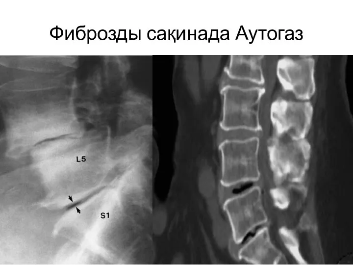 Фиброзды сақинада Аутогаз