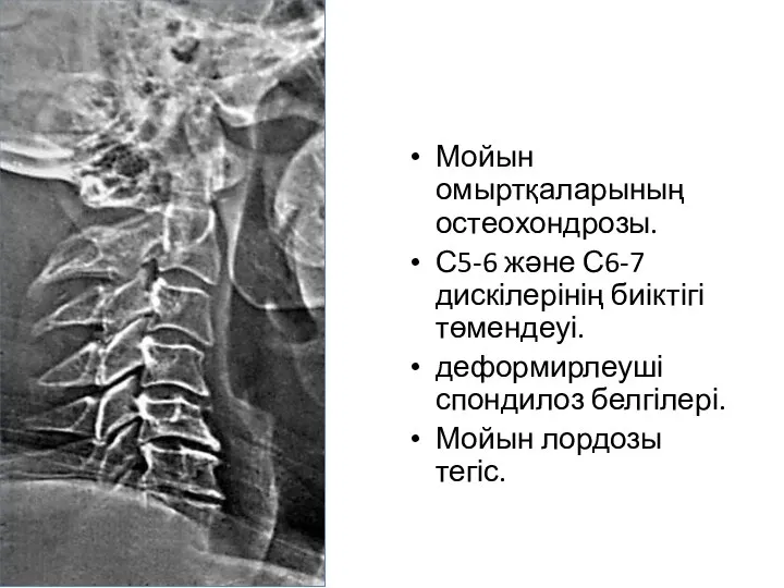 Мойын омыртқаларының остеохондрозы. С5-6 және С6-7 дискілерінің биіктігі төмендеуі. деформирлеуші спондилоз белгілері. Мойын лордозы тегіс.