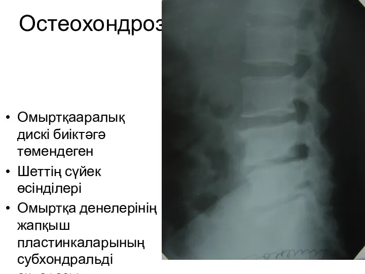 Остеохондроз Омыртқааралық дискі биіктәгә төмендеген Шеттің сүйек өсінділері Омыртқа денелерінің жапқыш пластинкаларының субхондральді склерозы