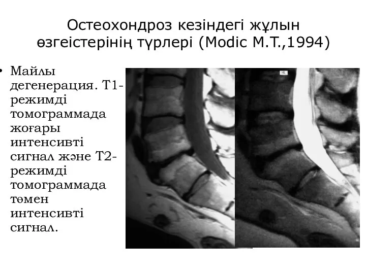 Остеохондроз кезіндегі жұлын өзгеістерінің түрлері (Modic M.T.,1994) Майлы дегенерация. Т1-режимді томограммада жоғары
