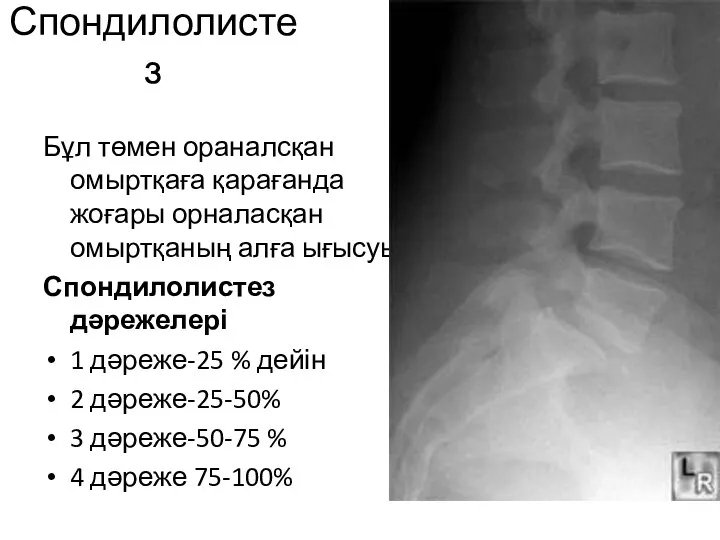 Спондилолистез Бұл төмен ораналсқан омыртқаға қарағанда жоғары орналасқан омыртқаның алға ығысуы. Спондилолистез