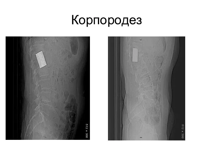 Корпородез