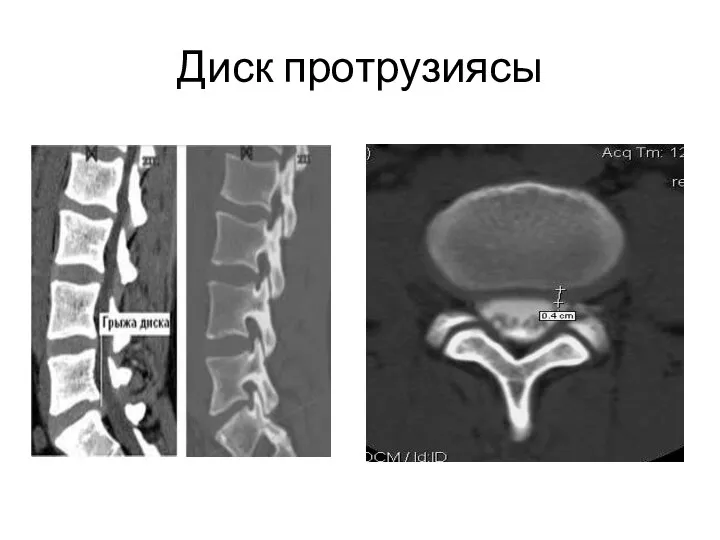 Диск протрузиясы