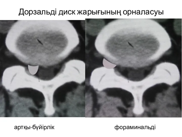 Дорзальді диск жарығының орналасуы артқы-бүйірлік фораминальді