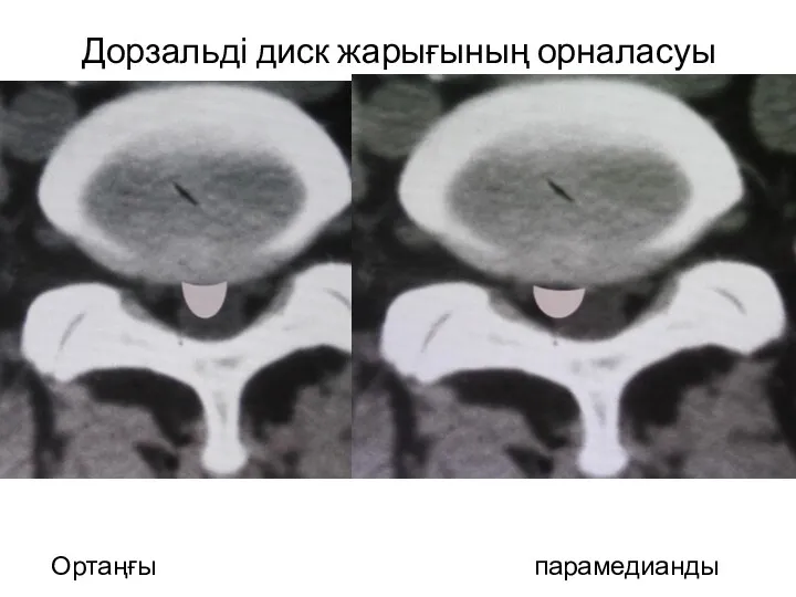 Дорзальді диск жарығының орналасуы Ортаңғы парамедианды