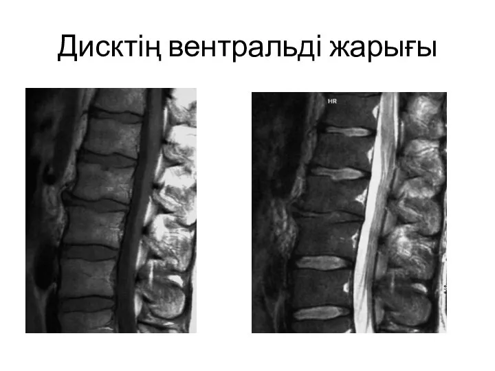 Дисктің вентральді жарығы