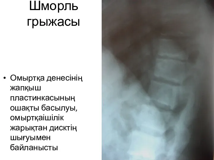 Шморль грыжасы Омыртқа денесінің жапқыш пластинкасының ошақты басылуы, омыртқаішілік жарықтан дисктің шығуымен байланысты