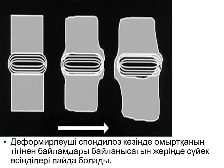 Деформирлеуші спондилоз кезінде омыртқаның тігінен байламдары байланысатын жерінде сүйек өсінділері пайда болады.